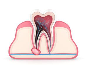 el paso root canal surgery