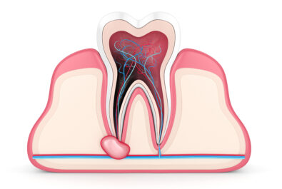 el paso root canal surgery