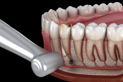 el paso root canal surgery