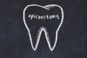 el paso root canal surgery