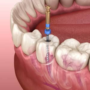 el paso root canal