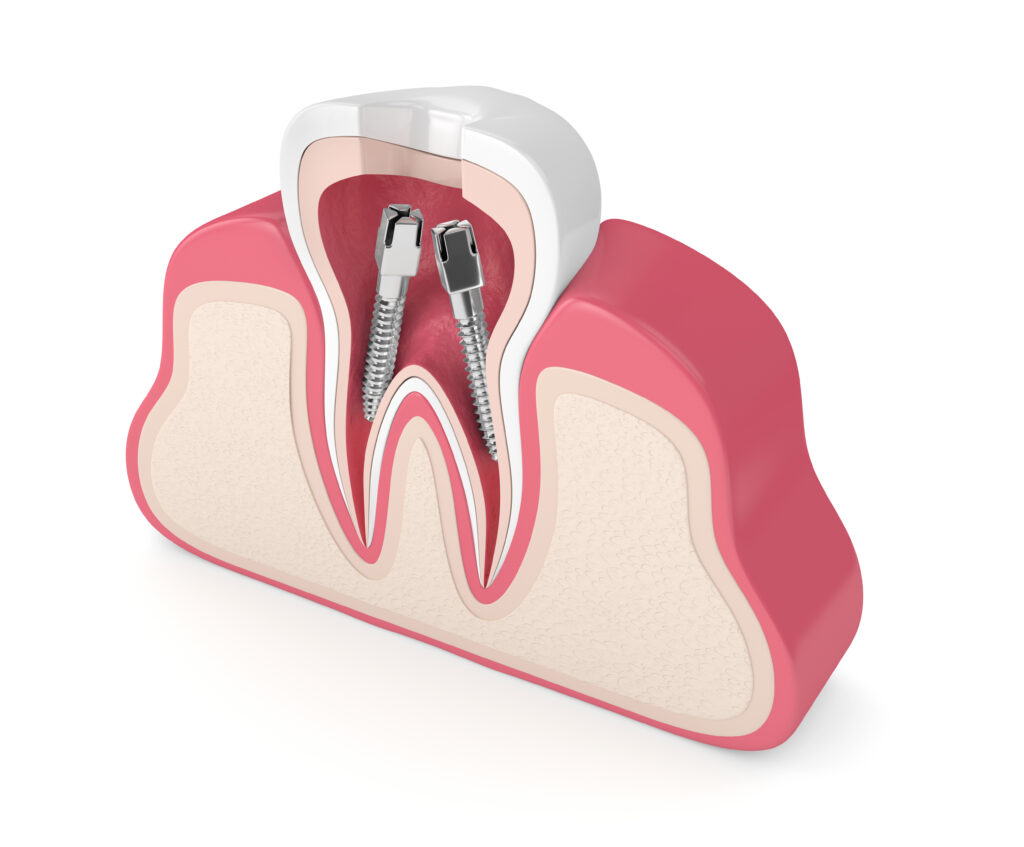Core Infecter When Your Infected Tooth Needs A Post And Core | El Paso, TX