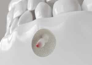 el paso root canal surgery
