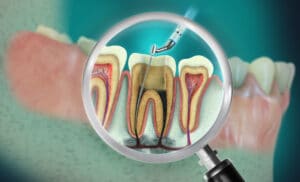 el paso root canals