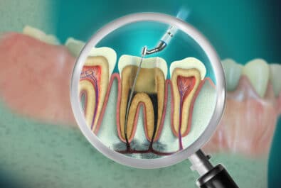 el paso root canals
