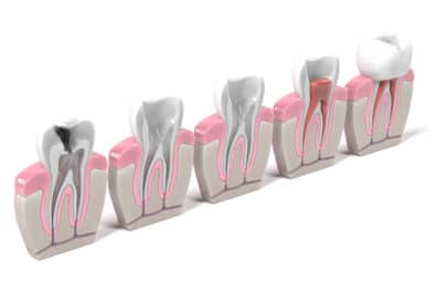 el paso root canal